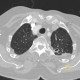 Pachypleuritis, apical, postspecific changes: CT - Computed tomography